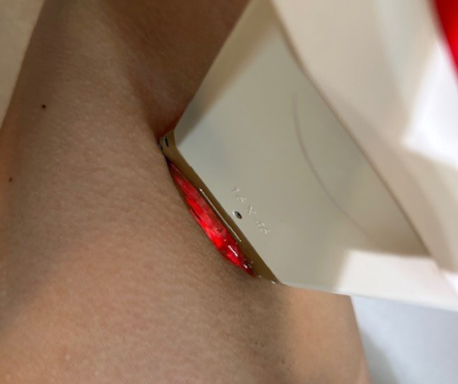 Intense pulsed light in use for laser hair removal